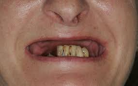 Estudo aponta que 16 milhões de brasileiros não possuem nenhum dente na boca  | Geral - Portal T5